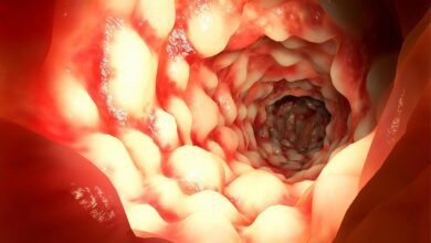 Crohns Mystery Solved Common Stomach Bug May Help Cause Inflammatory