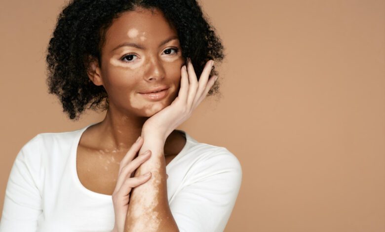 Vitiligo Symptoms Causes and Treatments