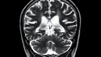 Significant Post COVID Brain Abnormalities Revealed by Special MRI