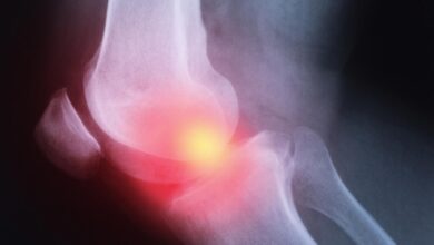 Groundbreaking Study Finds Treatment Effective for Rheumatoid Arthritis Patients