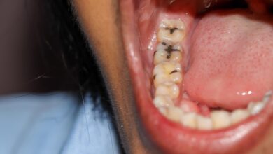 Using Vapes May Increase Risk of Developing Dental Cavities